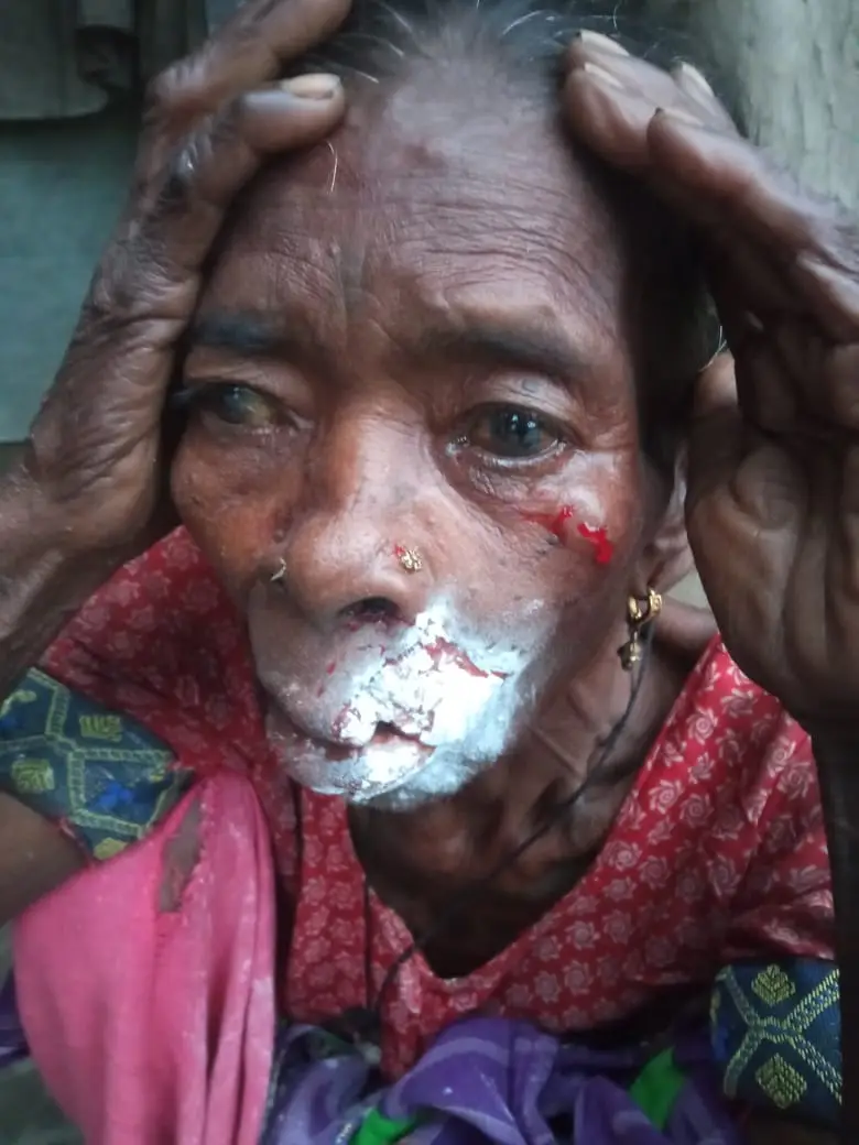 हल्दूचौड़ (लालकुआं) में वन्यजीव का खूनी हमला, महिला के चेहरे पर गंभीर चोटें